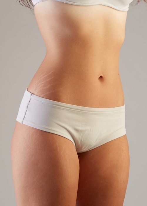 brazilian stretch mark camouflage price