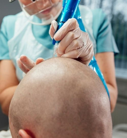 scalp micropigmentation procedure phoenix az mussa beauty studio