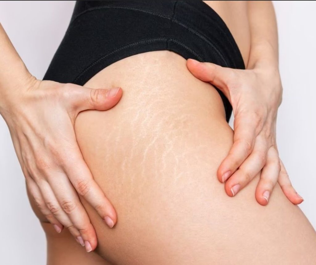 stretch marks